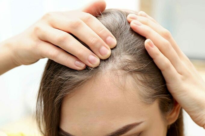 Haarausfall Bei Fettiger Kopfhaut. Haben Die Beiden Eine Verbindung