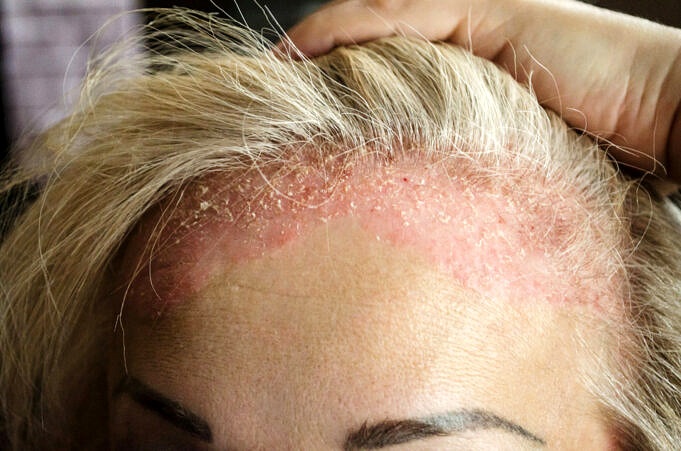 Juckende Kopfhaut Haarausfall Ursachen Und Behandlungen